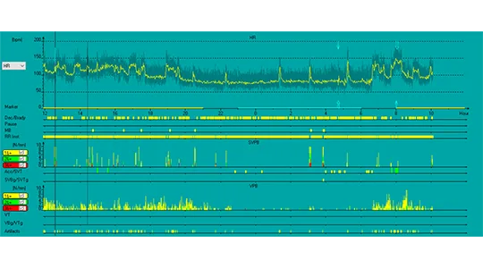 SPIDERSAS Holter analysis 1
