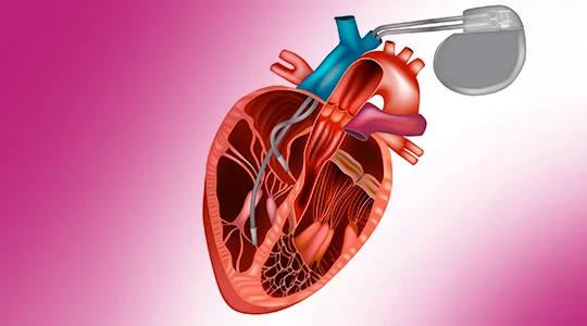 Bradicardia Patients Abnormal Heartbeat bradycardia4 1